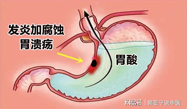 中医治疗胃溃疡大出血，急则治标缓则治本，整体调理有妙招