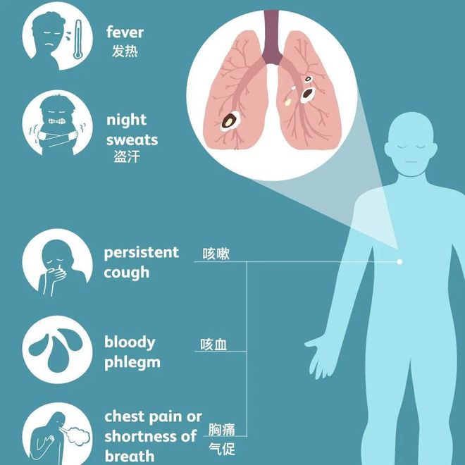 肺结核严重吗?_肺结核严重了会引起什么后果_肺结核严重症状有哪些表现