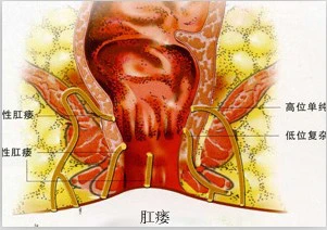 肛门失禁的案例-难以启齿的病症：肛门失禁如何影响一个人的生活