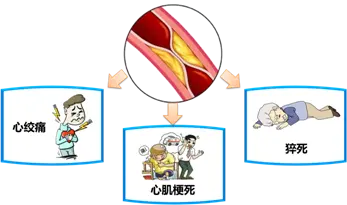 冠心病护理计划单范文_护理冠心病标准计划怎么写_冠心病标准护理计划