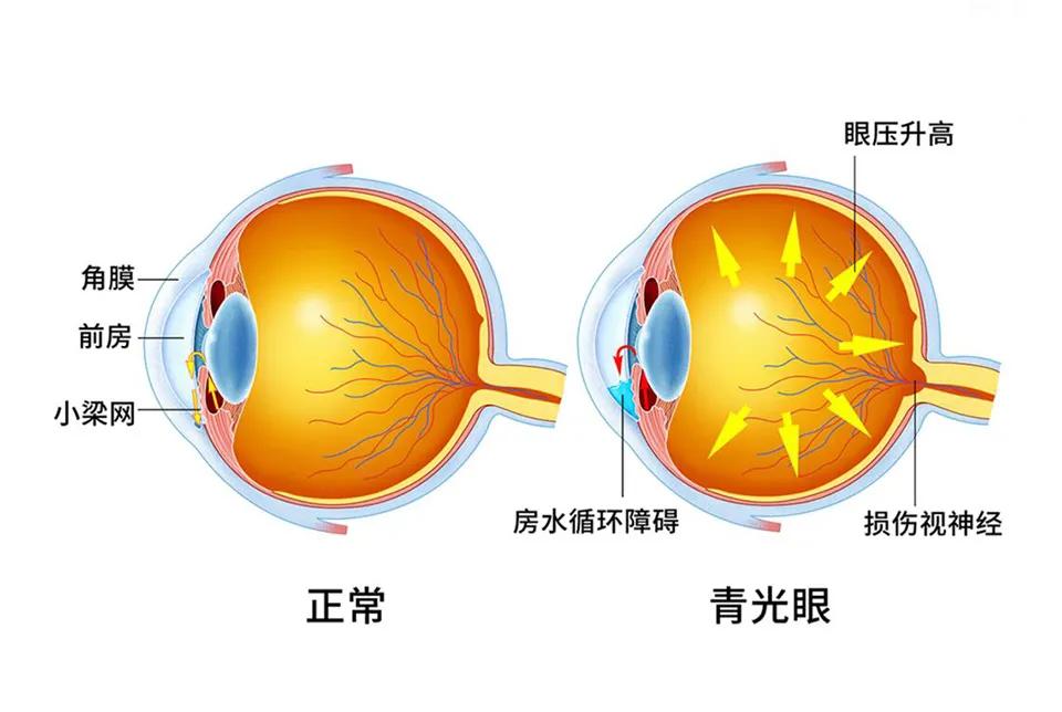 药物性青光眼护理措施_药物相关性青光眼_药物治疗青光眼的主要目标