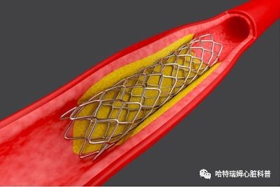 冠心病如何治疗-冠心病治疗：从生活细节到药物手术，全面呵护心脏健康