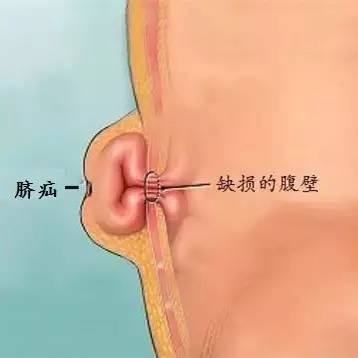 股疝手术步骤_股疝术式_股疝手术视频丁香园