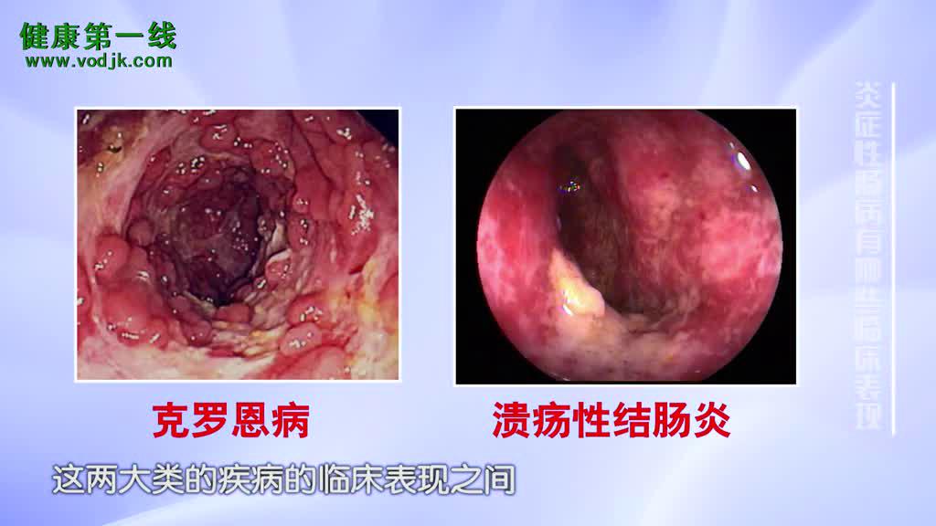 克罗恩氏病_罗克罗恩病_罗克恩病是什么病