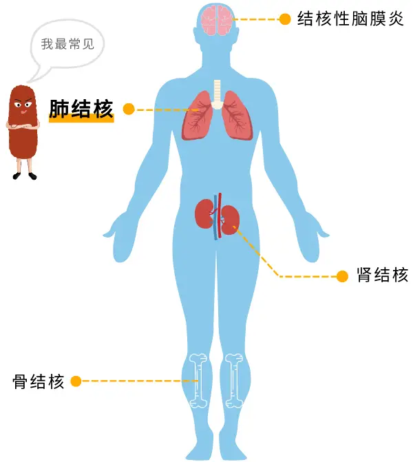 肺结核的严重程度分类_三型肺结核严重吗_肺结核严重性