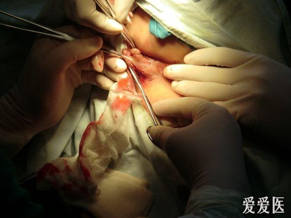 肛门失禁手术_肛门手术失禁原因_肛门手术后失禁