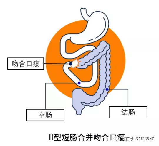 克罗恩病并发症的护理-克罗恩病并发症如何护理？耐心爱心缺一不可