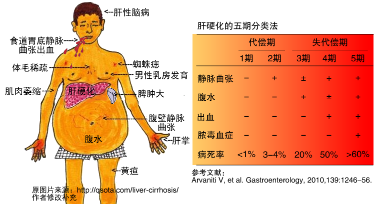 肝硬化肝腹水饮食_肝硬化饮食腹水怎么调理_肝硬化大量腹水饮食
