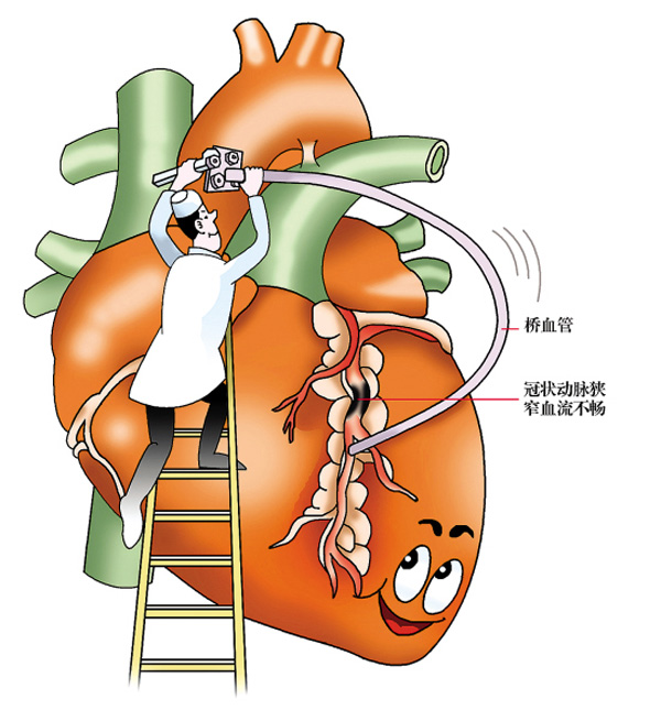 冠心病的护理诊断及护理措施_护理诊断冠心病措施有哪些_护理诊断冠心病措施不包括