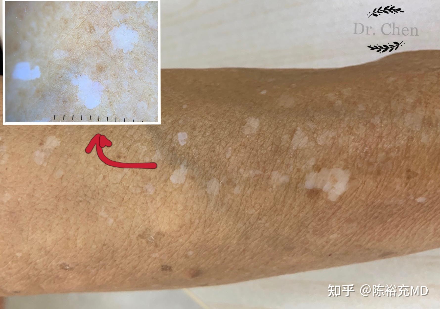 皮肤病血毒丸的功效与作用_毒丸子的危害_什么是毒丸防御